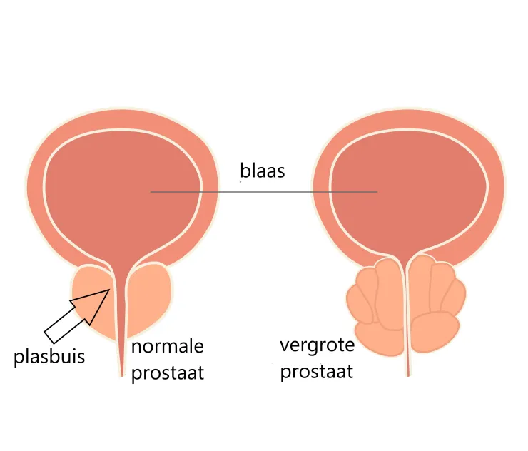 prostaatvergroting en erectiestoornis