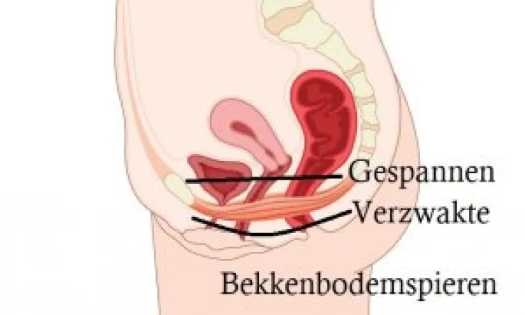 Bekkenbodemspieren te zwak of te gespannen