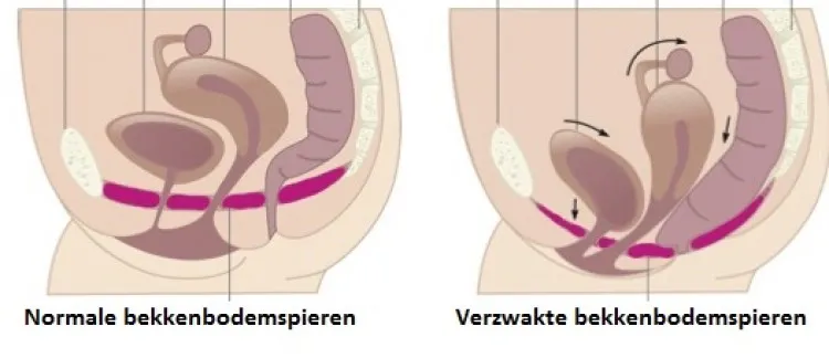 verschil normale bekkenbodem en verzwakte bekkenbodemspieren