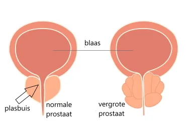 prostaatvergroting en erectiestoornis